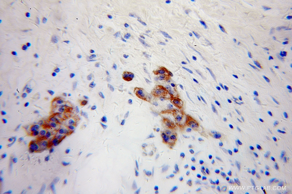 IHC staining of human pancreas cancer using 10889-1-AP