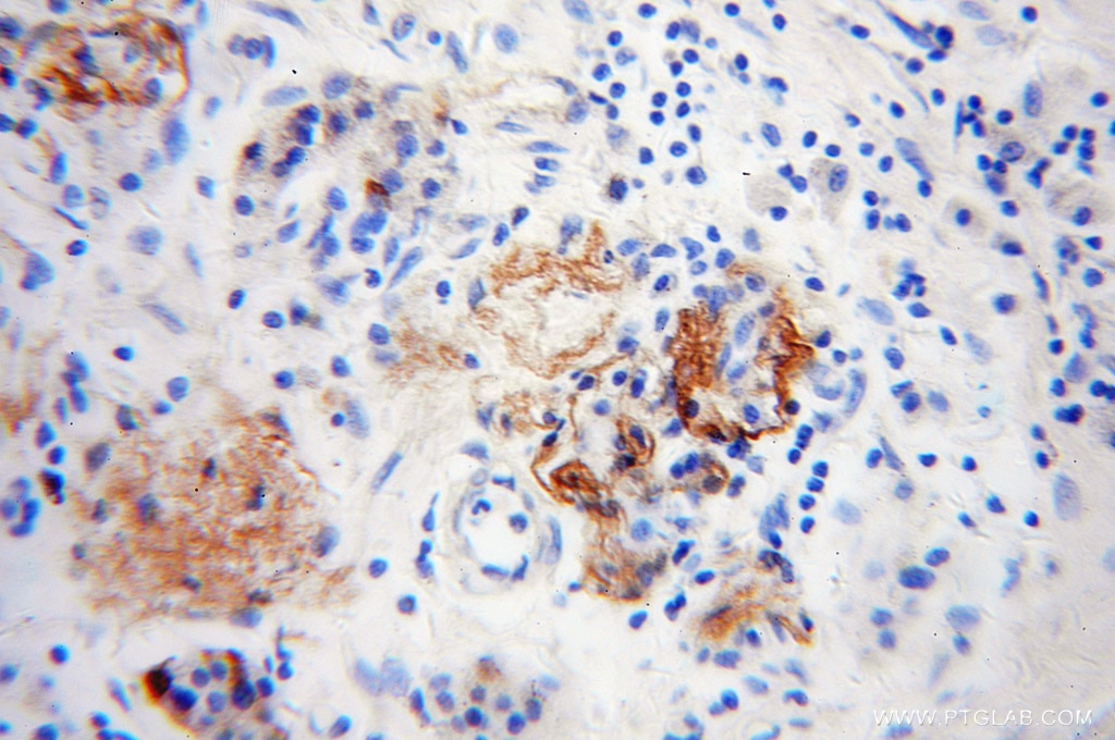 Immunohistochemistry (IHC) staining of human pancreas cancer tissue using Neuropeptide Y Polyclonal antibody (12833-1-AP)