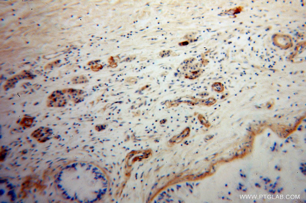 Immunohistochemistry (IHC) staining of human pancreas cancer tissue using Neuropeptide Y Polyclonal antibody (12833-1-AP)
