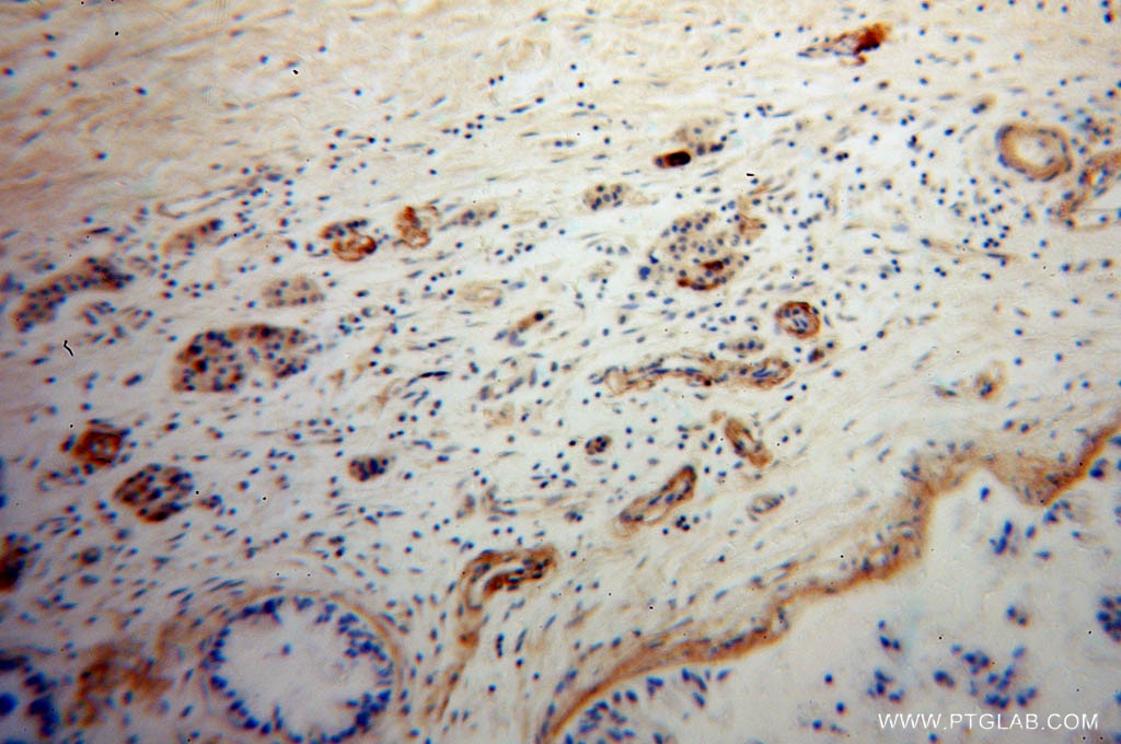 IHC staining of human pancreas cancer using 12833-1-AP