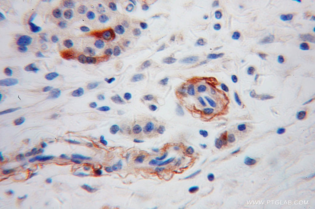 Immunohistochemistry (IHC) staining of human pancreas cancer tissue using Neuropeptide Y Polyclonal antibody (12833-1-AP)