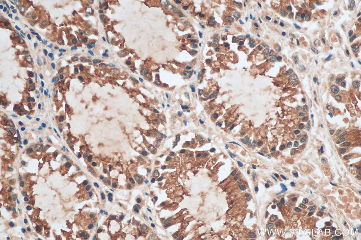 Immunohistochemistry (IHC) staining of human colon cancer tissue using NQO1 Polyclonal antibody (11451-1-AP)
