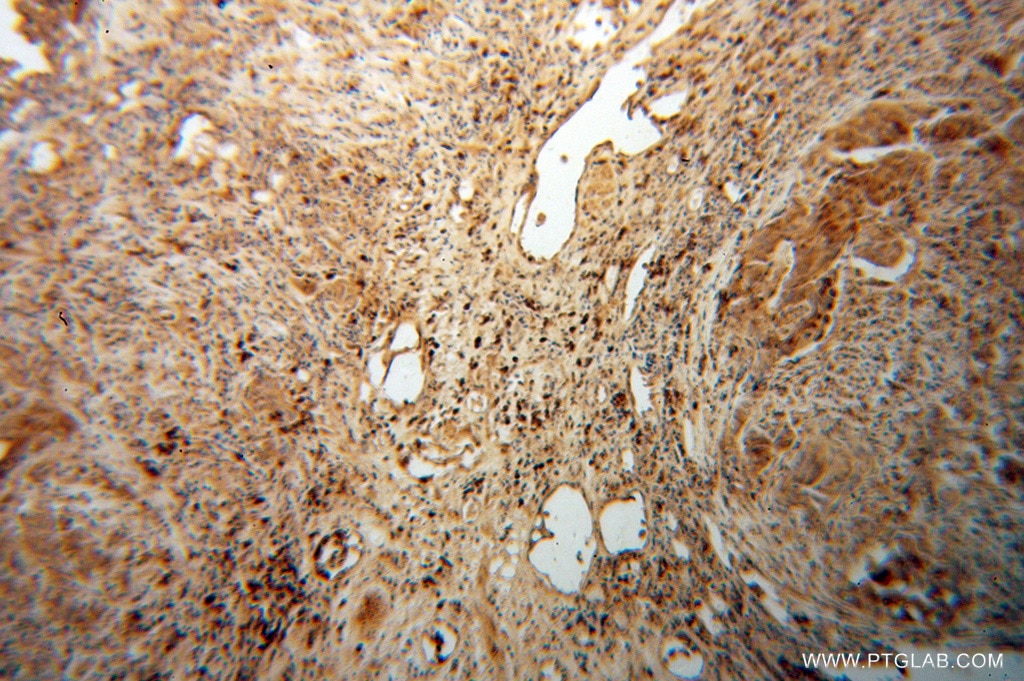 Immunohistochemistry (IHC) staining of human prostate cancer tissue using NR2C1 Polyclonal antibody (13658-1-AP)