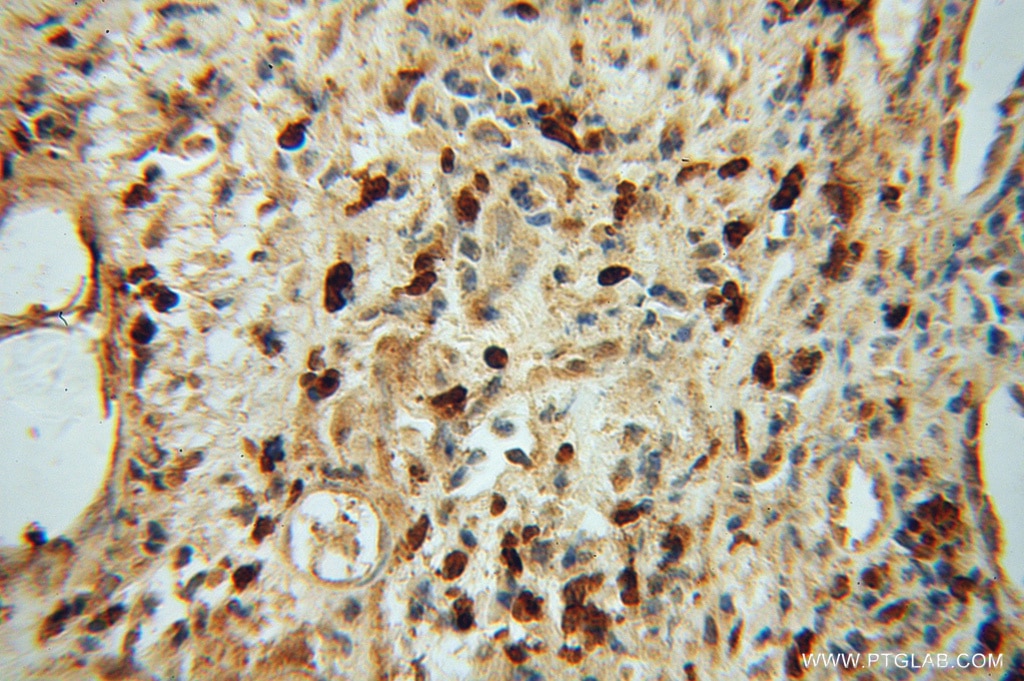 Immunohistochemistry (IHC) staining of human prostate cancer tissue using NR2C1 Polyclonal antibody (13658-1-AP)