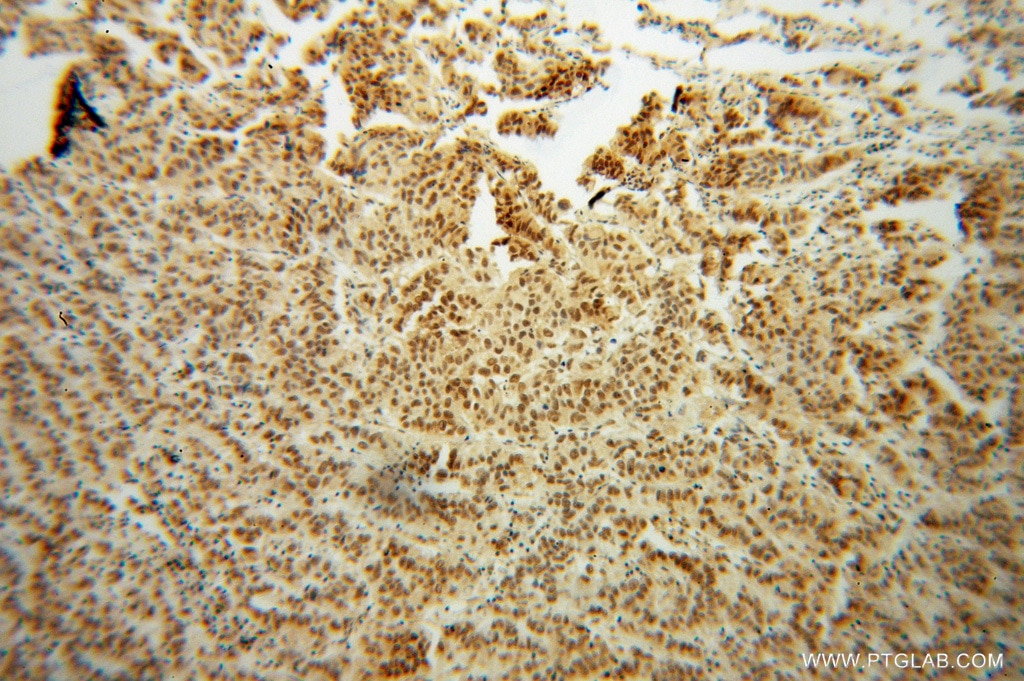 Immunohistochemistry (IHC) staining of human prostate cancer tissue using NR2E3 Polyclonal antibody (14246-1-AP)