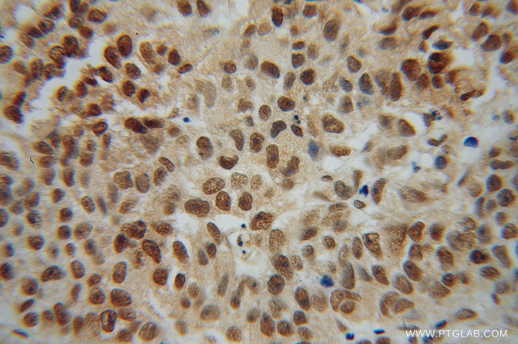 Immunohistochemistry (IHC) staining of human prostate cancer tissue using NR2E3 Polyclonal antibody (14246-1-AP)