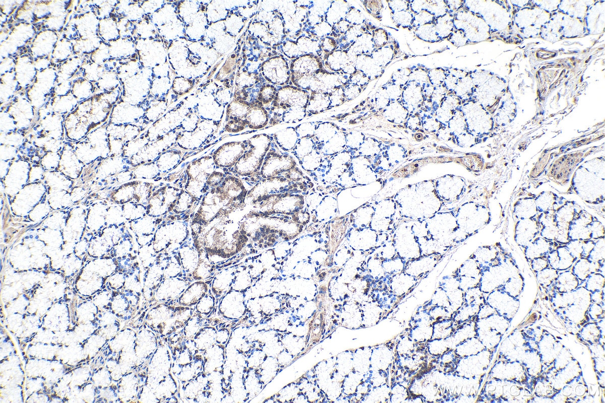 IHC staining of human stomach cancer using 24573-1-AP