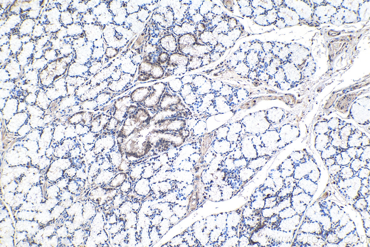 Immunohistochemistry (IHC) staining of human stomach cancer tissue using NR2F1 Polyclonal antibody (24573-1-AP)