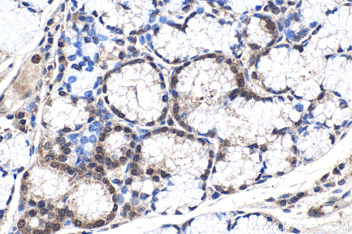 Immunohistochemistry (IHC) staining of human stomach cancer tissue using NR2F1 Polyclonal antibody (24573-1-AP)