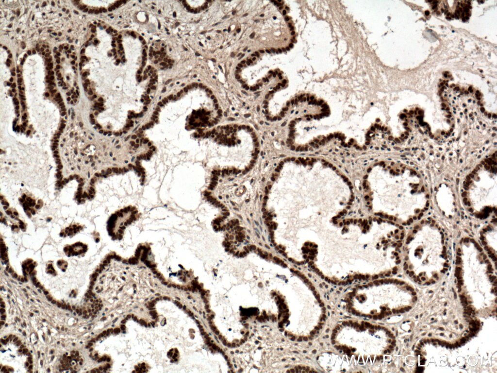 Immunohistochemistry (IHC) staining of human ovary tumor tissue using NR2F6 Monoclonal antibody (60117-2-Ig)