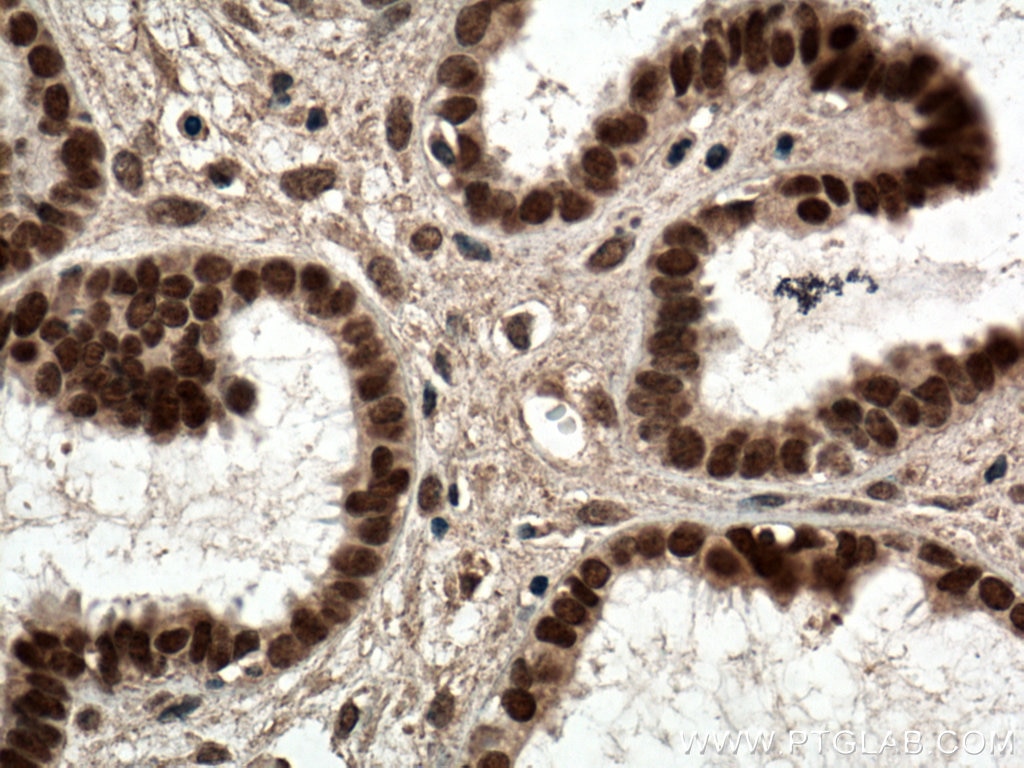 Immunohistochemistry (IHC) staining of human ovary tumor tissue using NR2F6 Monoclonal antibody (60117-2-Ig)
