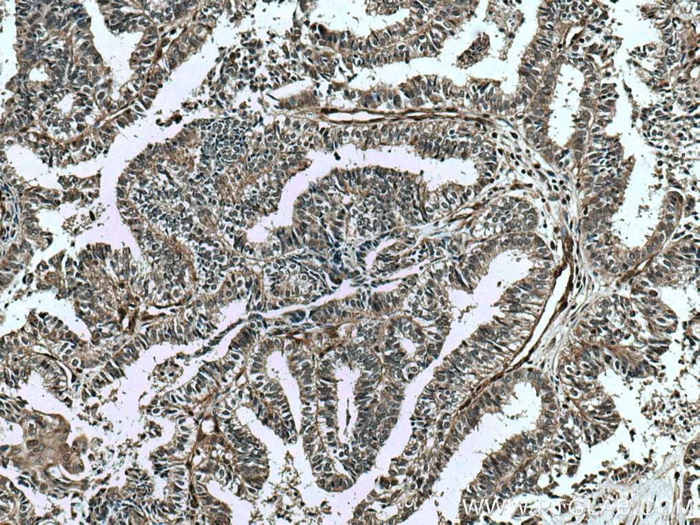 Immunohistochemistry (IHC) staining of human ovary tumor tissue using Glucocorticoid receptor Polyclonal antibody (24050-1-AP)
