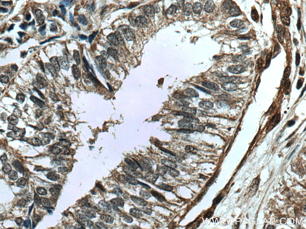 IHC staining of human ovary tumor using 24050-1-AP