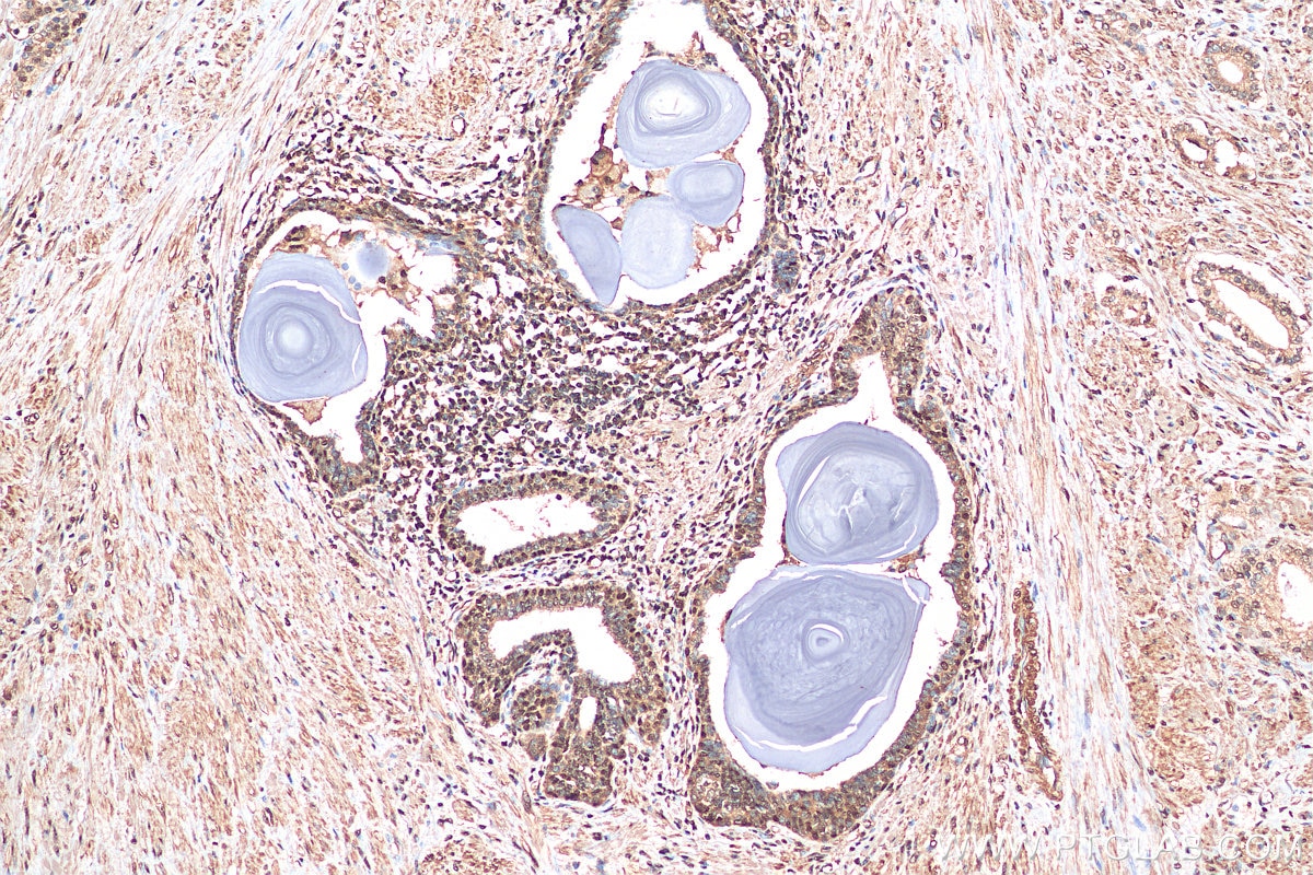 Immunohistochemistry (IHC) staining of human prostate cancer tissue using Glucocorticoid receptor Polyclonal antibody (24050-1-AP)