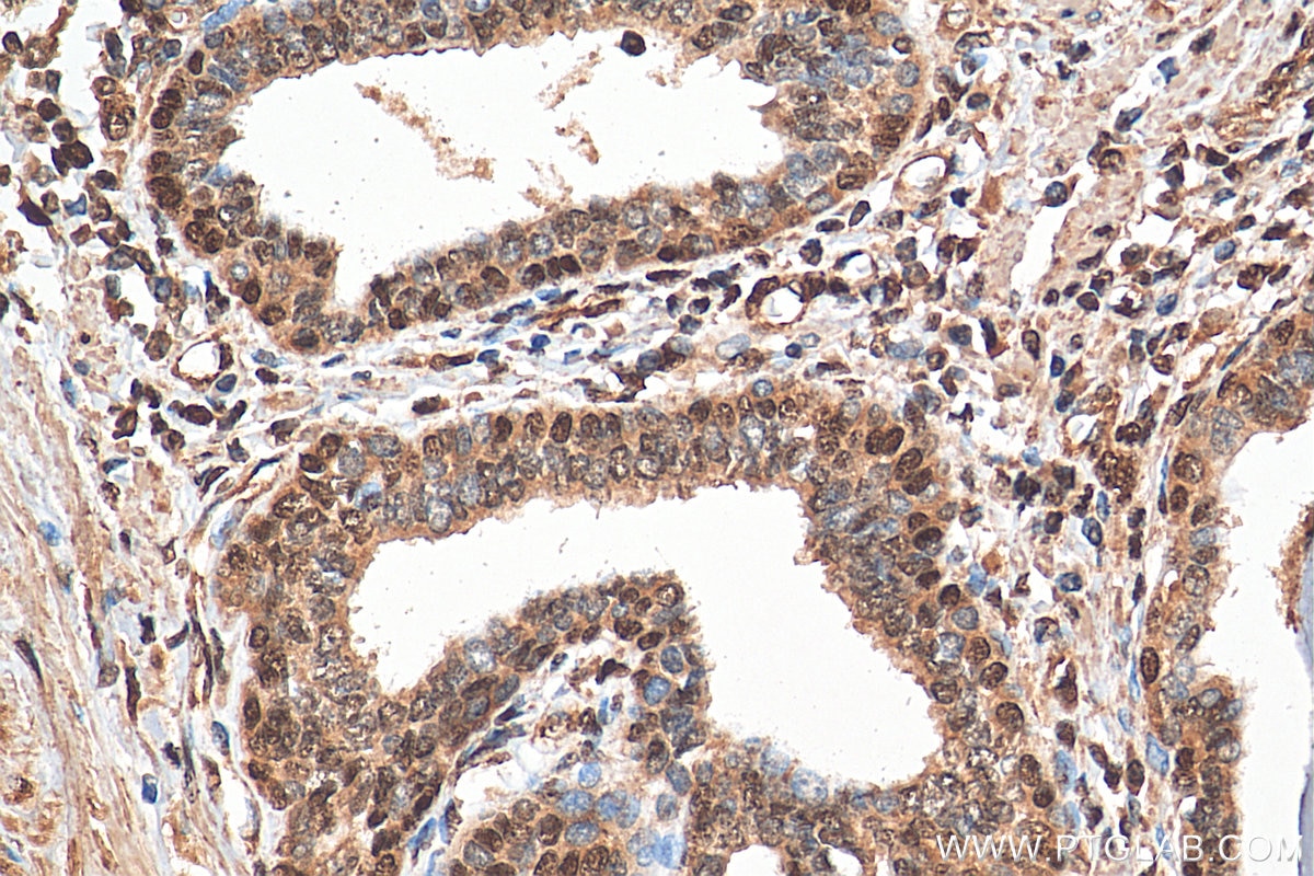 Immunohistochemistry (IHC) staining of human prostate cancer tissue using Glucocorticoid receptor Polyclonal antibody (24050-1-AP)