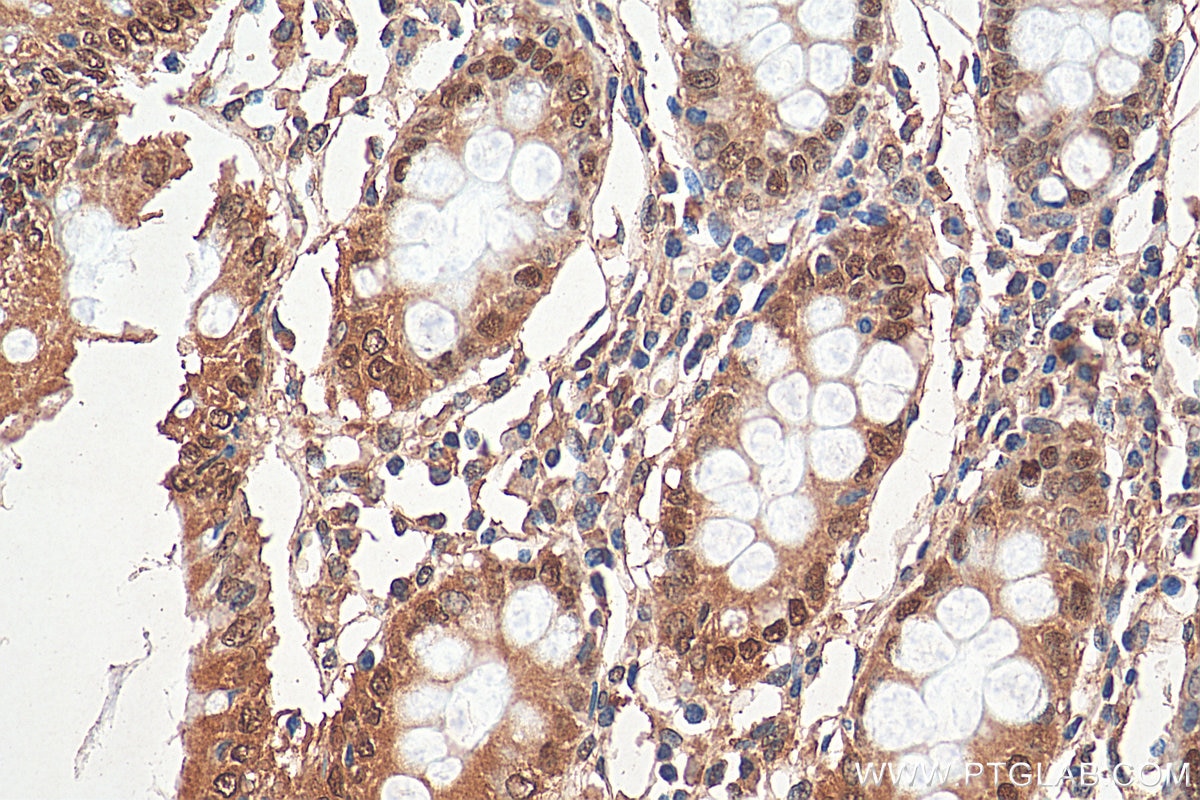 Immunohistochemistry (IHC) staining of human colon tissue using NR3C2 Polyclonal antibody (21854-1-AP)
