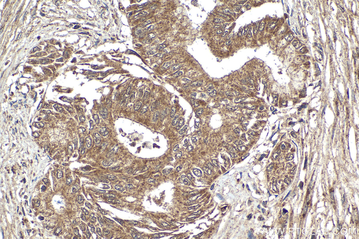 IHC staining of human pancreas cancer using 12235-1-AP