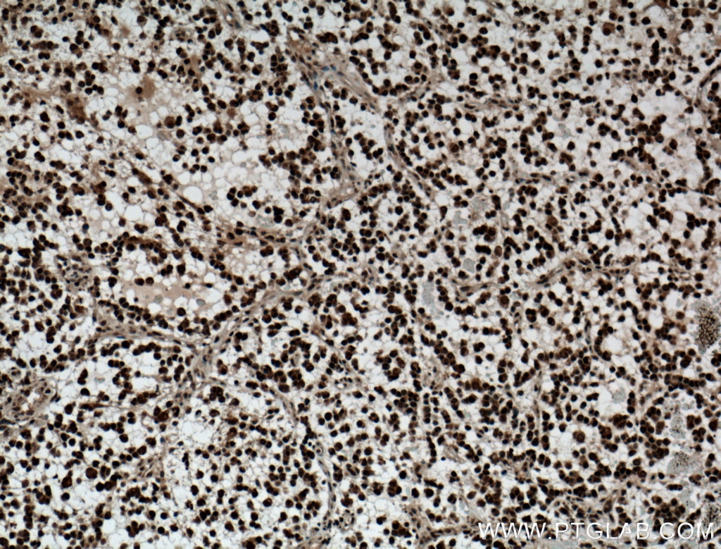 Immunohistochemistry (IHC) staining of human gliomas tissue using Nurr1/NR4A2 Polyclonal antibody (10975-2-AP)