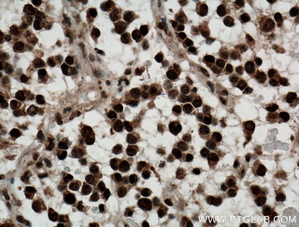 Immunohistochemistry (IHC) staining of human gliomas tissue using Nurr1/NR4A2 Polyclonal antibody (10975-2-AP)