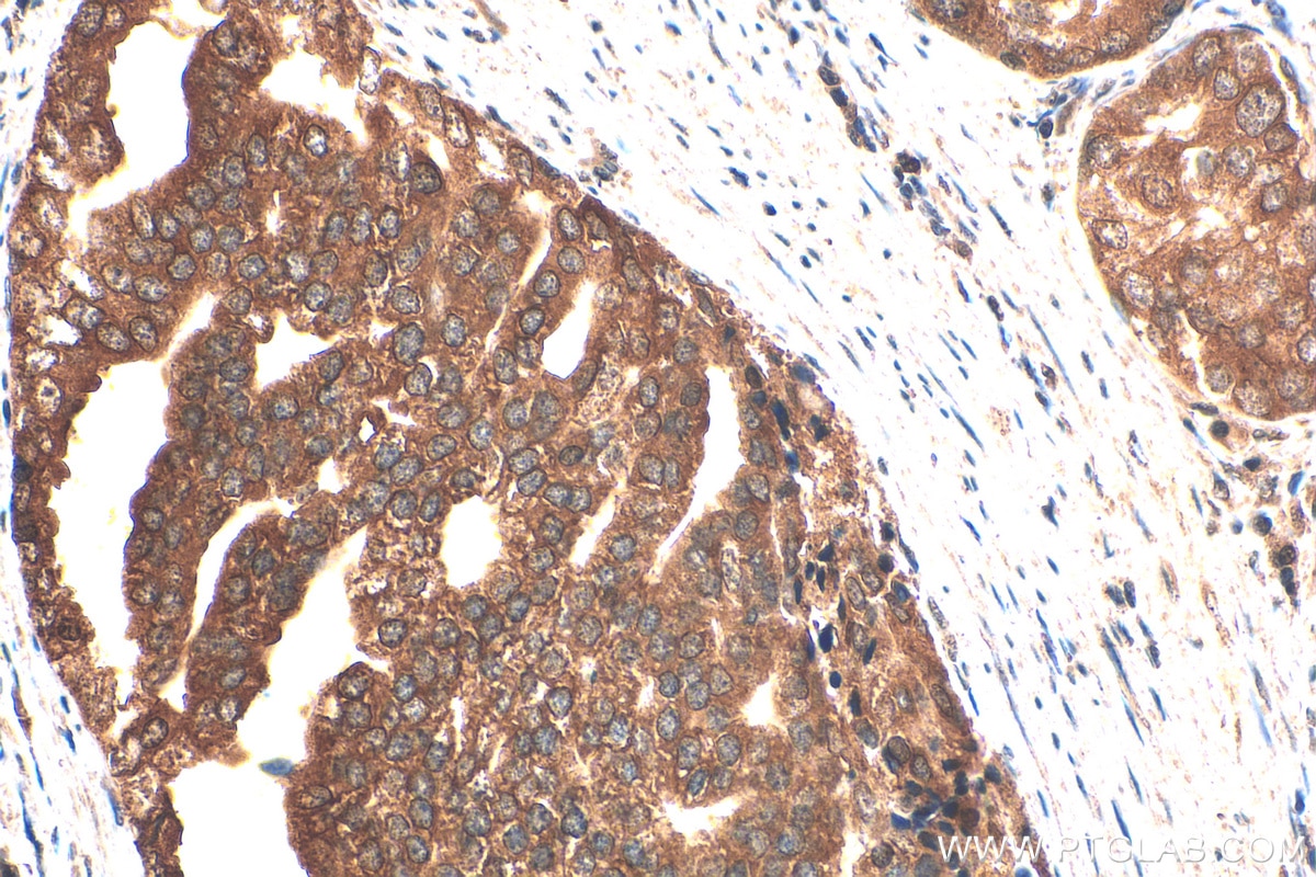 Immunohistochemistry (IHC) staining of human prostate cancer tissue using Nurr1/NR4A2 Monoclonal antibody (66878-1-Ig)