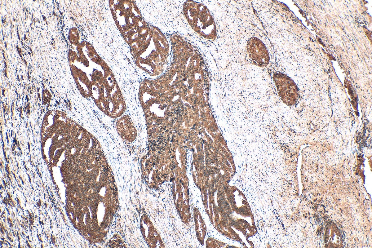 Immunohistochemistry (IHC) staining of human prostate cancer tissue using Nurr1/NR4A2 Monoclonal antibody (66878-1-Ig)