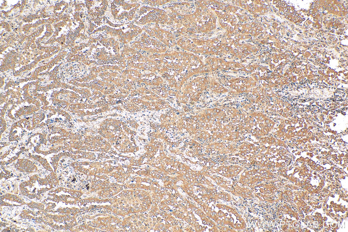 Immunohistochemistry (IHC) staining of human lung cancer tissue using NRARP Polyclonal antibody (14588-1-AP)