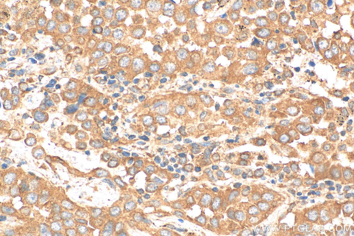 Immunohistochemistry (IHC) staining of human lung cancer tissue using NRARP Polyclonal antibody (14588-1-AP)