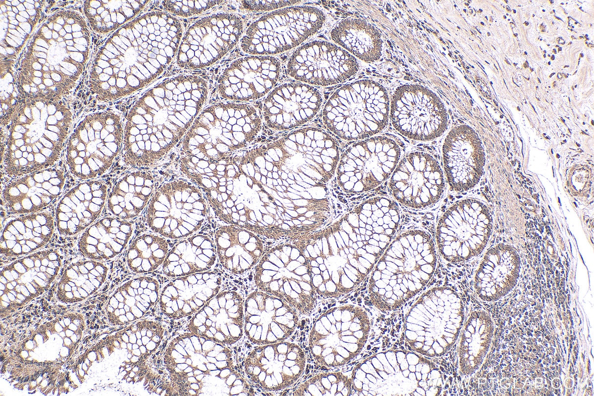 IHC staining of human colon cancer using 18296-1-AP