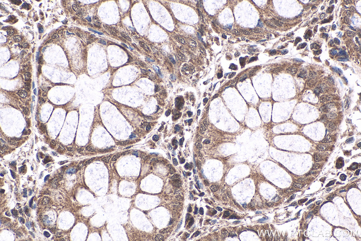 Immunohistochemistry (IHC) staining of human colon cancer tissue using NRAS-Specific Polyclonal antibody (18296-1-AP)