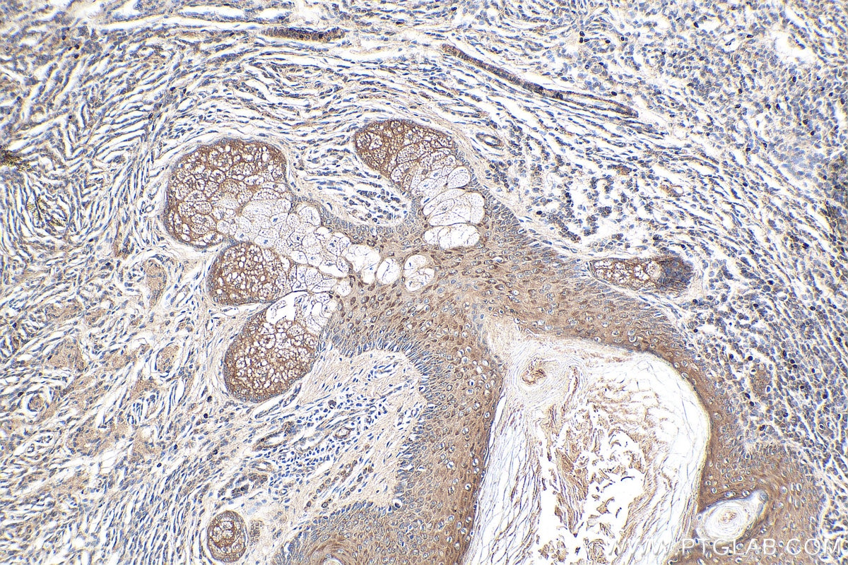 IHC staining of human malignant melanoma using 18296-1-AP