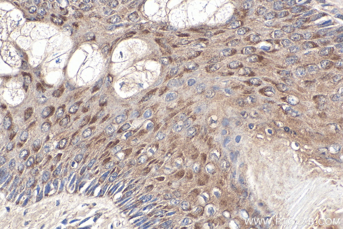 Immunohistochemistry (IHC) staining of human malignant melanoma tissue using NRAS-Specific Polyclonal antibody (18296-1-AP)
