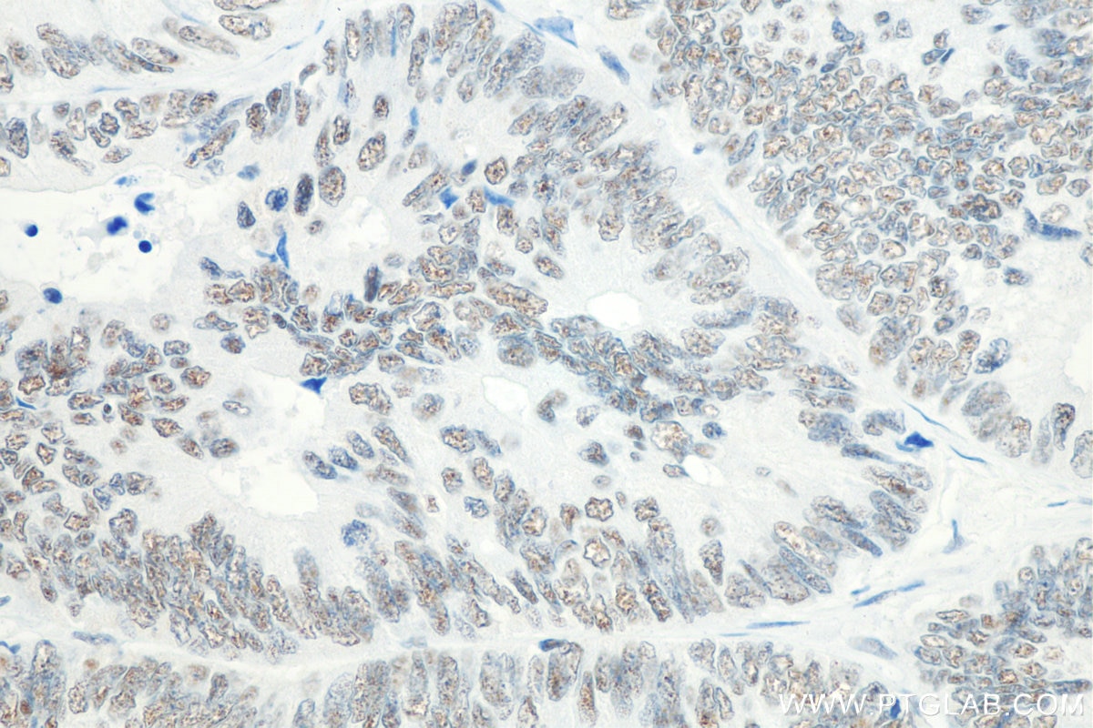 Immunohistochemistry (IHC) staining of human colon cancer tissue using NRF1/nuclear respiratory factor 1 Monoclonal antib (66832-1-Ig)