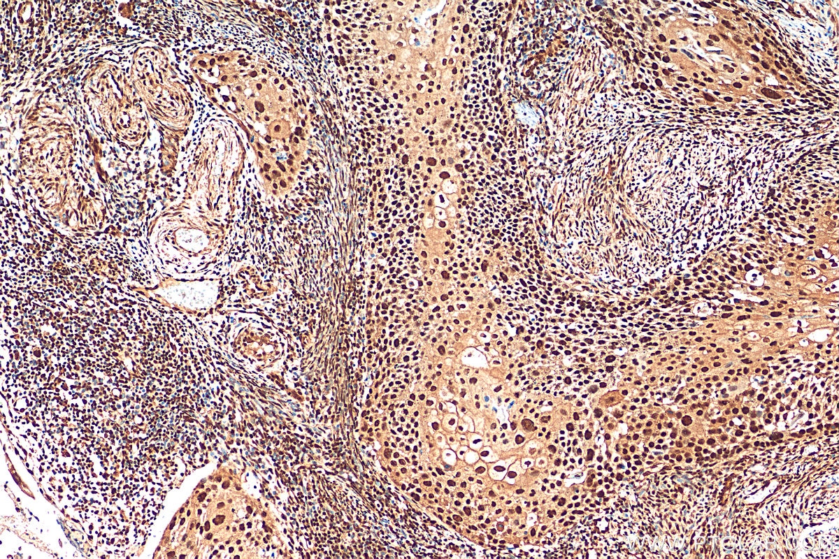 Immunohistochemistry (IHC) staining of human cervical cancer tissue using GABPA Polyclonal antibody (21542-1-AP)