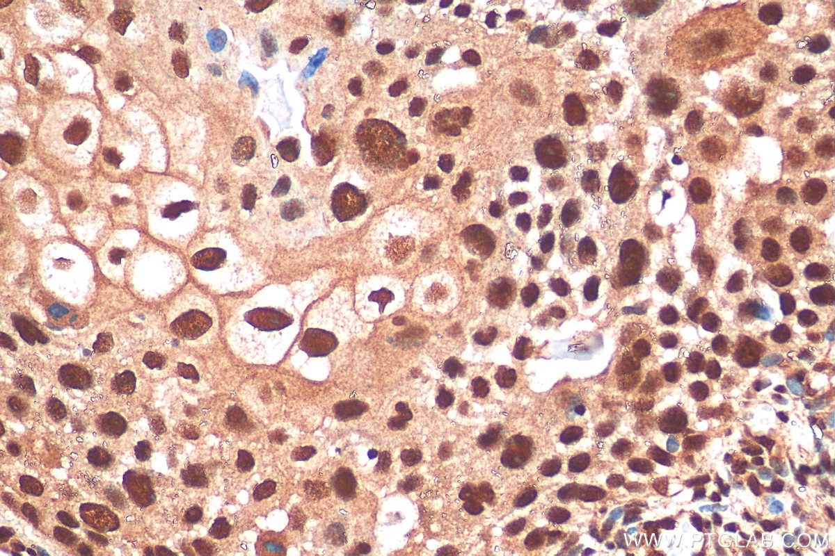 Immunohistochemistry (IHC) staining of human cervical cancer tissue using GABPA Polyclonal antibody (21542-1-AP)