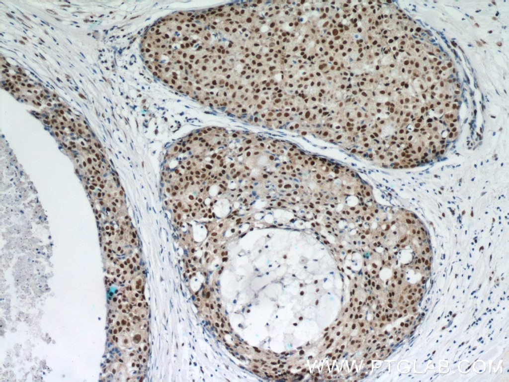 Immunohistochemistry (IHC) staining of human breast cancer tissue using GABPA Polyclonal antibody (21542-1-AP)