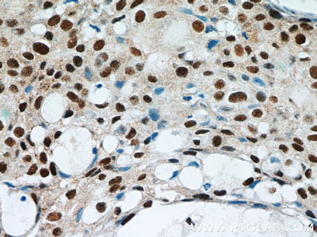 Immunohistochemistry (IHC) staining of human breast cancer tissue using GABPA Polyclonal antibody (21542-1-AP)