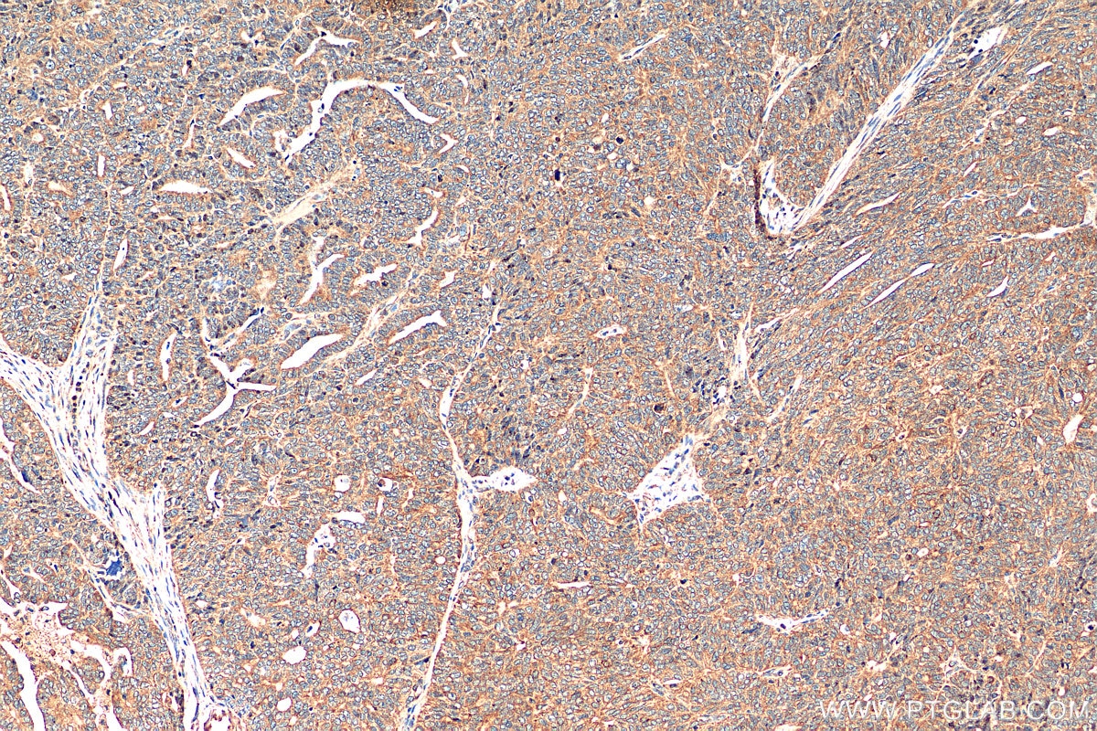 Immunohistochemistry (IHC) staining of human ovary tumor tissue using NRF2, NFE2L2 Recombinant antibody (80593-1-RR)