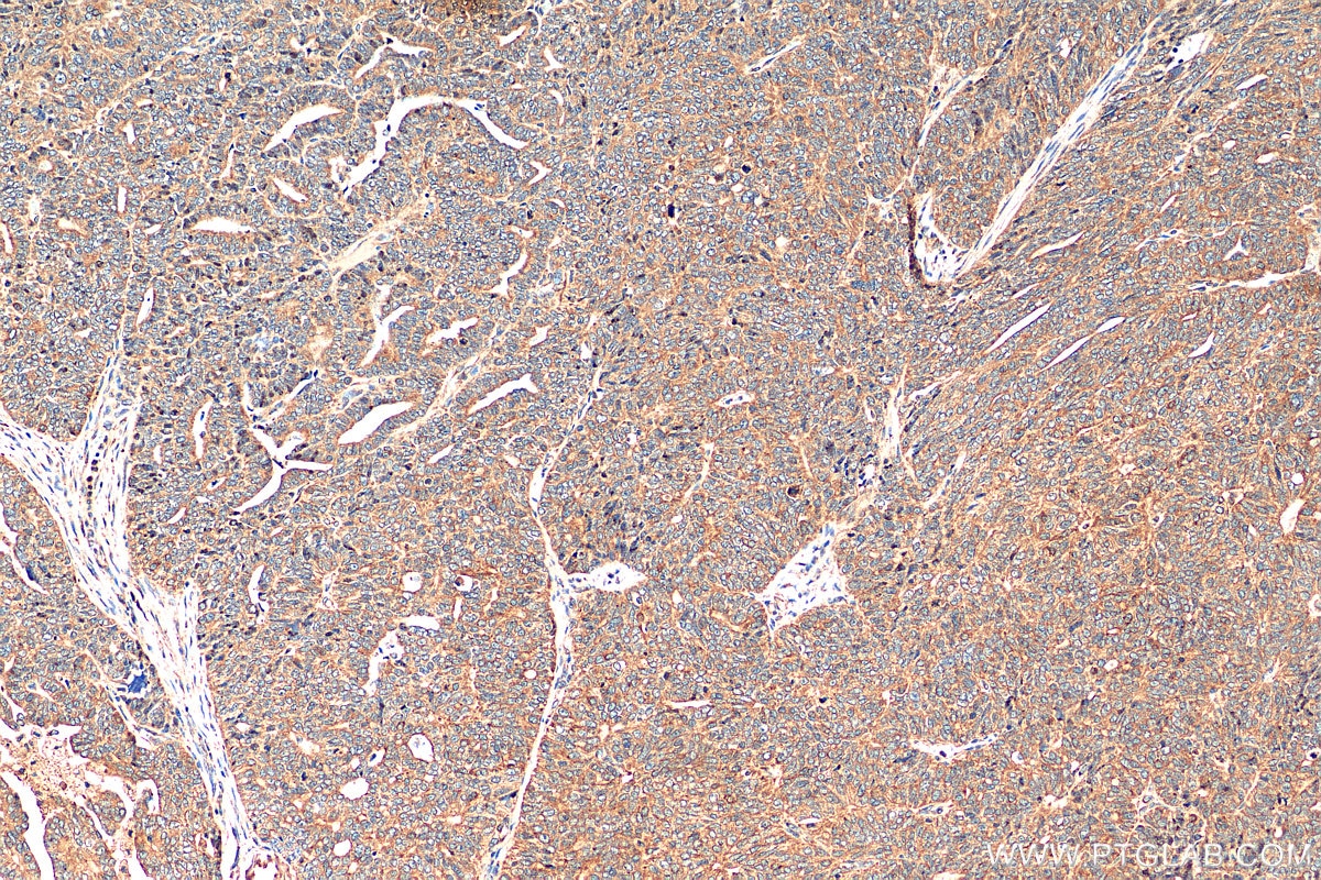 IHC staining of human ovary tumor using 80593-1-RR