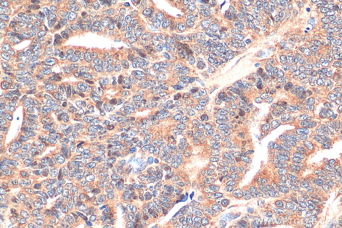 Immunohistochemistry (IHC) staining of human ovary tumor tissue using NRF2, NFE2L2 Recombinant antibody (80593-1-RR)