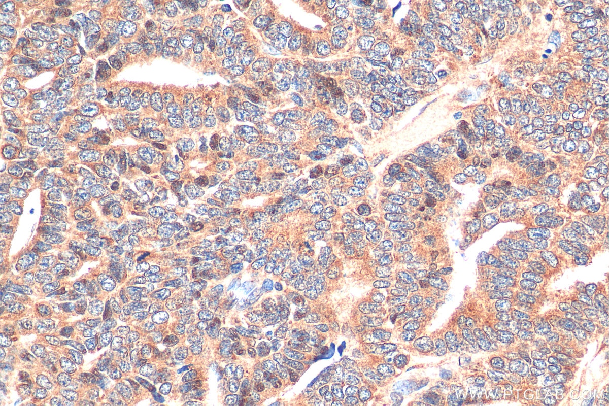 IHC staining of human ovary tumor using 80593-1-RR