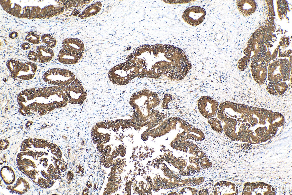 Immunohistochemistry (IHC) staining of human pancreas cancer tissue using NRF2, NFE2L2 Recombinant antibody (80593-1-RR)