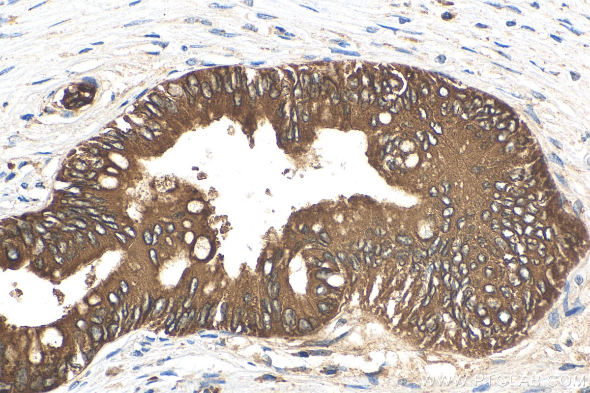 IHC staining of human pancreas cancer using 80593-1-RR