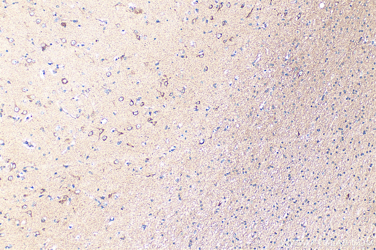 Immunohistochemistry (IHC) staining of human gliomas tissue using NRG2 Polyclonal antibody (20690-1-AP)