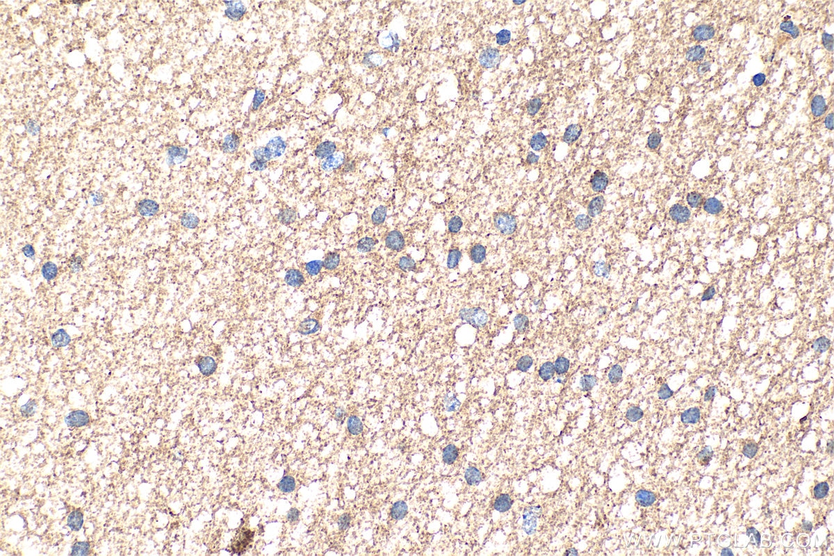 Immunohistochemistry (IHC) staining of human gliomas tissue using NRG2 Polyclonal antibody (20690-1-AP)