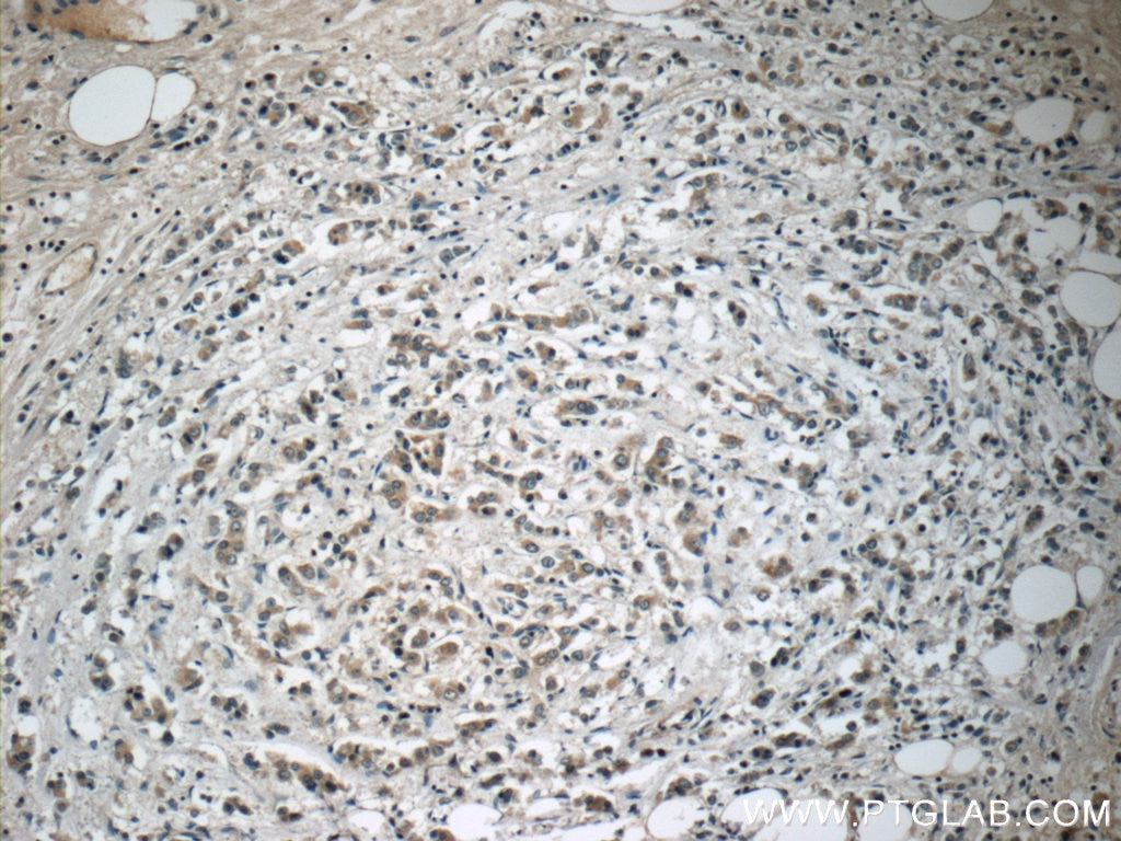 Immunohistochemistry (IHC) staining of human breast cancer tissue using NRG4 Polyclonal antibody (11206-1-AP)