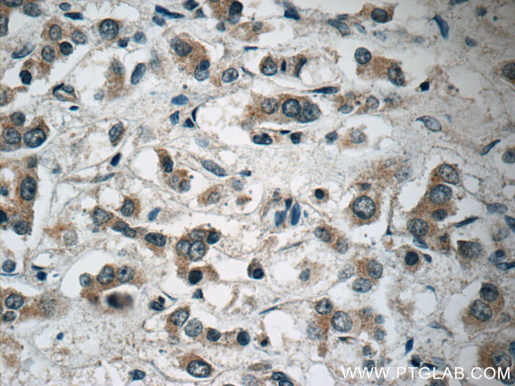 Immunohistochemistry (IHC) staining of human breast cancer tissue using NRG4 Polyclonal antibody (11206-1-AP)