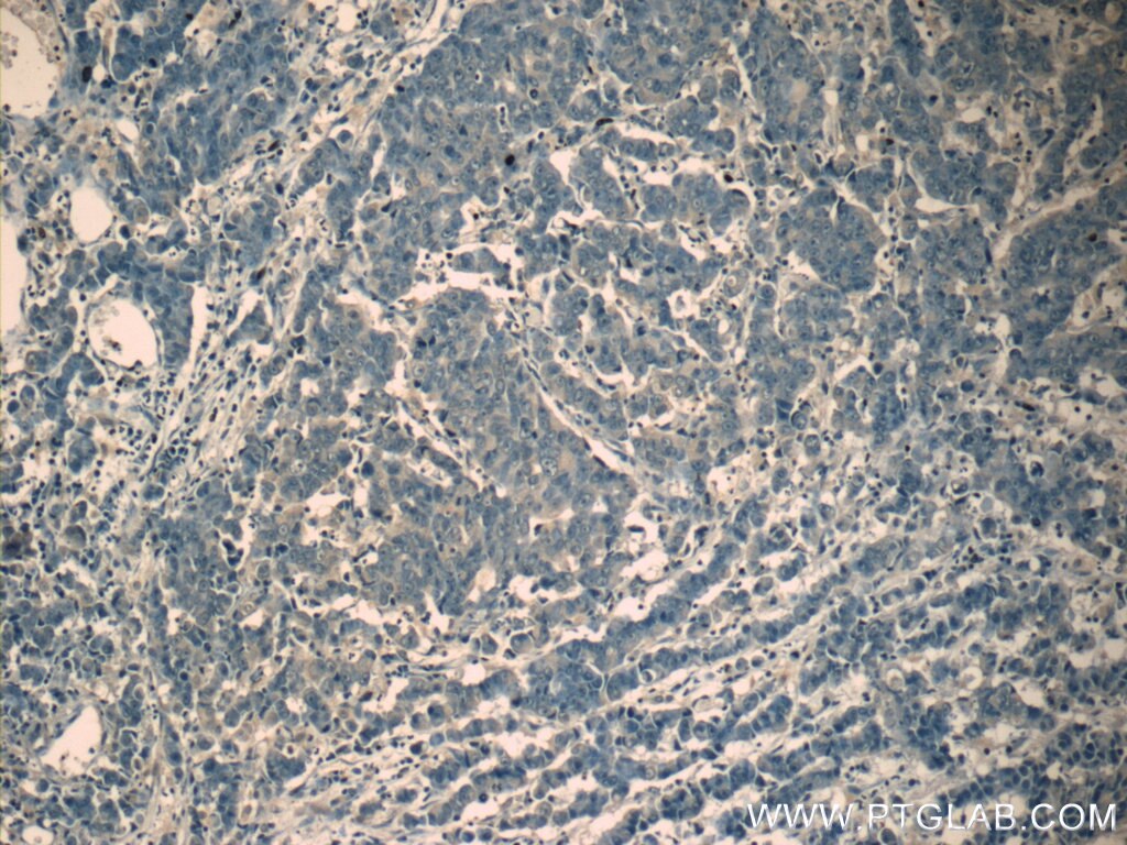 Immunohistochemistry (IHC) staining of human prostate cancer tissue using NRG4 Polyclonal antibody (11206-1-AP)