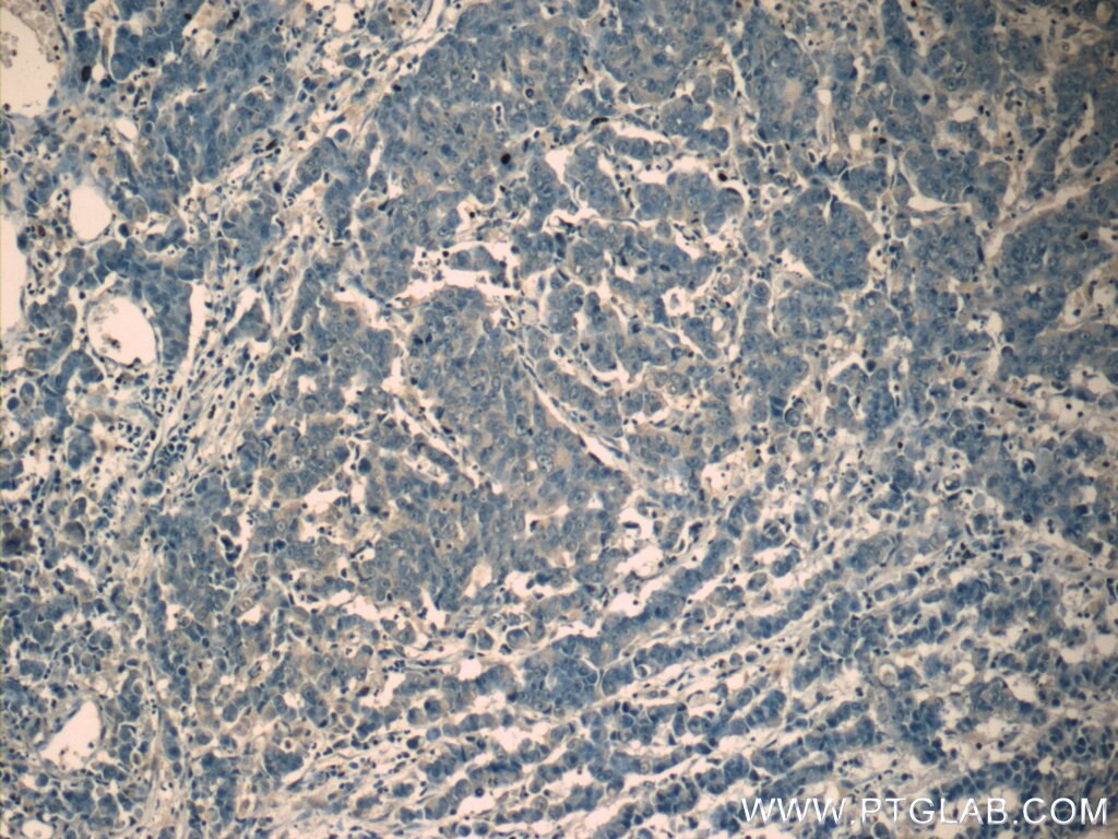 IHC staining of human prostate cancer using 11206-1-AP