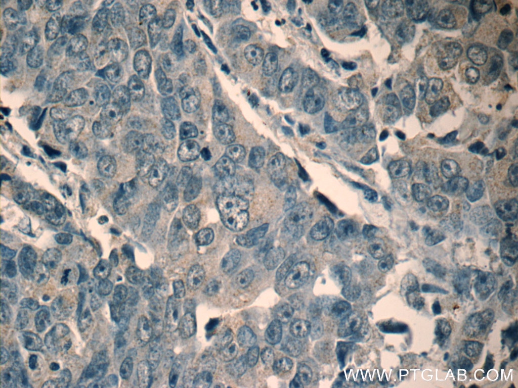 IHC staining of human prostate cancer using 11206-1-AP