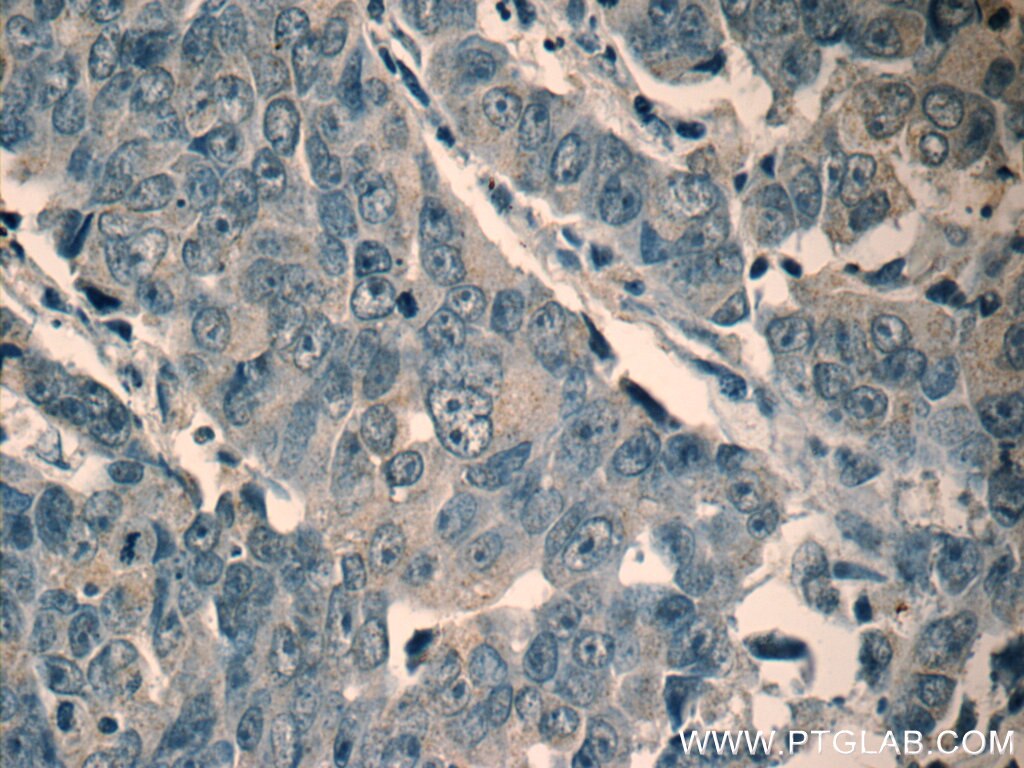 Immunohistochemistry (IHC) staining of human prostate cancer tissue using NRG4 Polyclonal antibody (11206-1-AP)